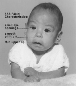 https://commons.wikimedia.org/wiki/File:Photo_of_baby_with_FAS.jpg