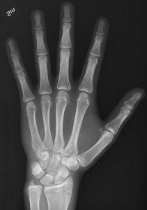 X-Ray image of the bones in a hand