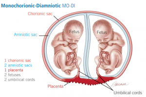 Illustrative image of twins in utero to demonstrate the categorization of shared or distinct amniotic or chorionic sacs